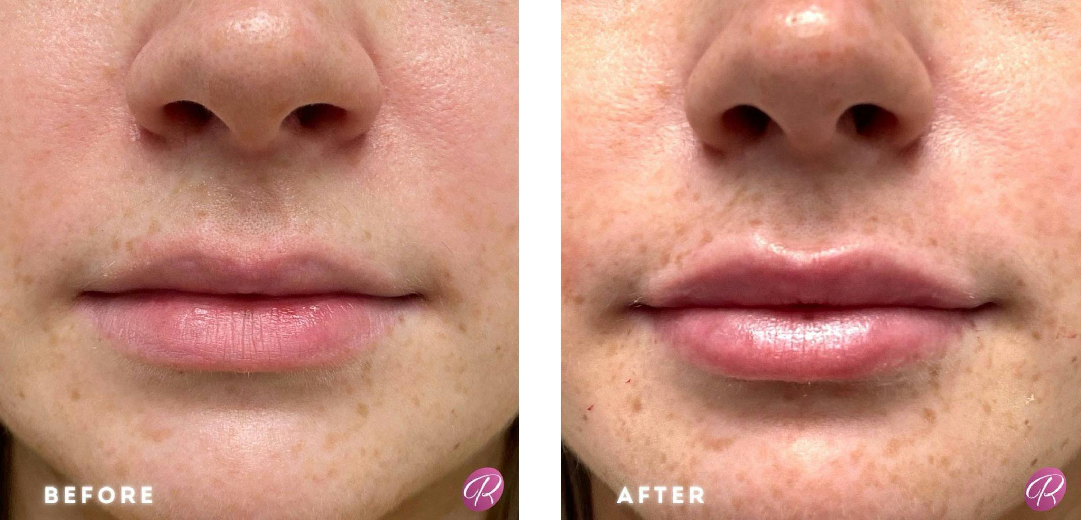 Juvederm Before & After Gallery - Patient 86641297 - Image 1