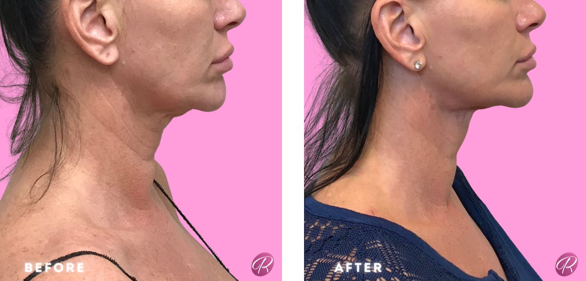 FaceTite Before & After Gallery - Patient 86641321 - Image 1