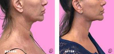 FaceTite Before & After Gallery - Patient 86641321 - Image 1