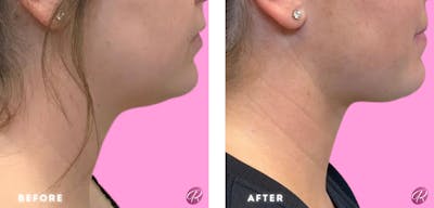 FaceTite Before & After Gallery - Patient 86641334 - Image 1