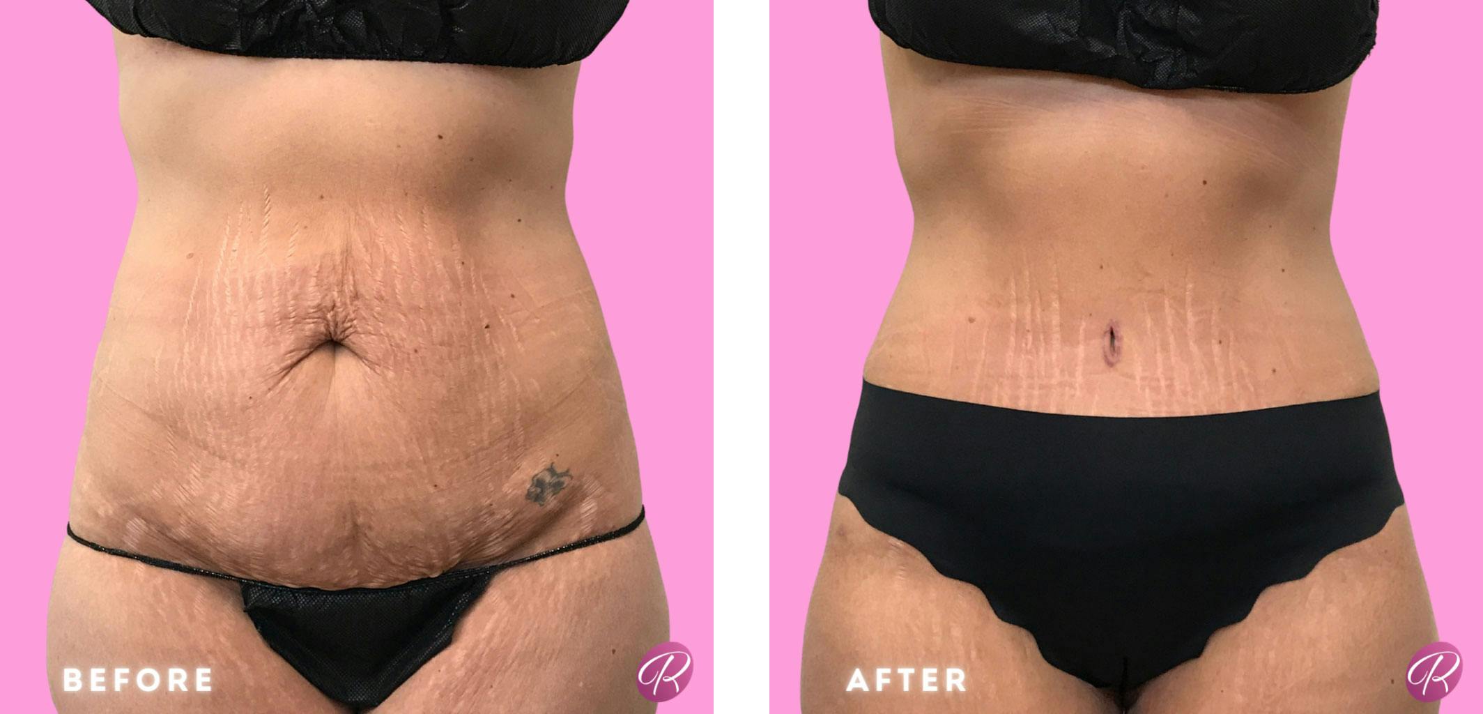 Tummy Tuck and Abdominoplasty