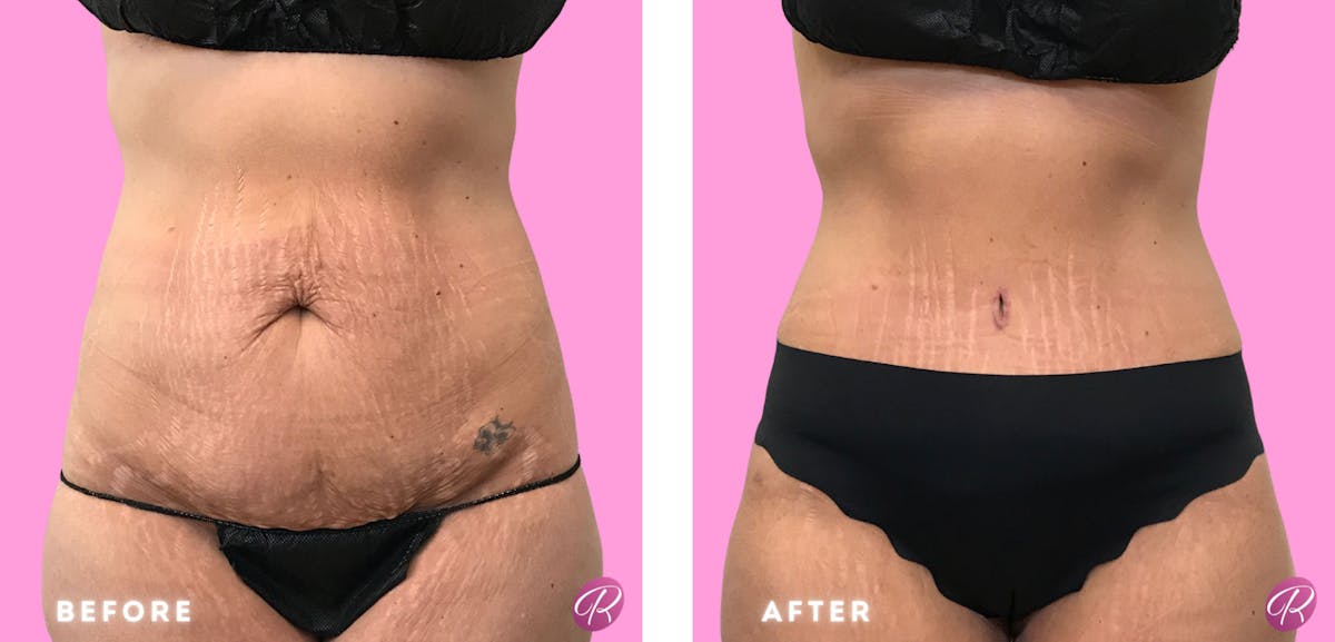Tummy Tuck and Abdominoplasty Before & After Gallery - Patient 86641336 - Image 1