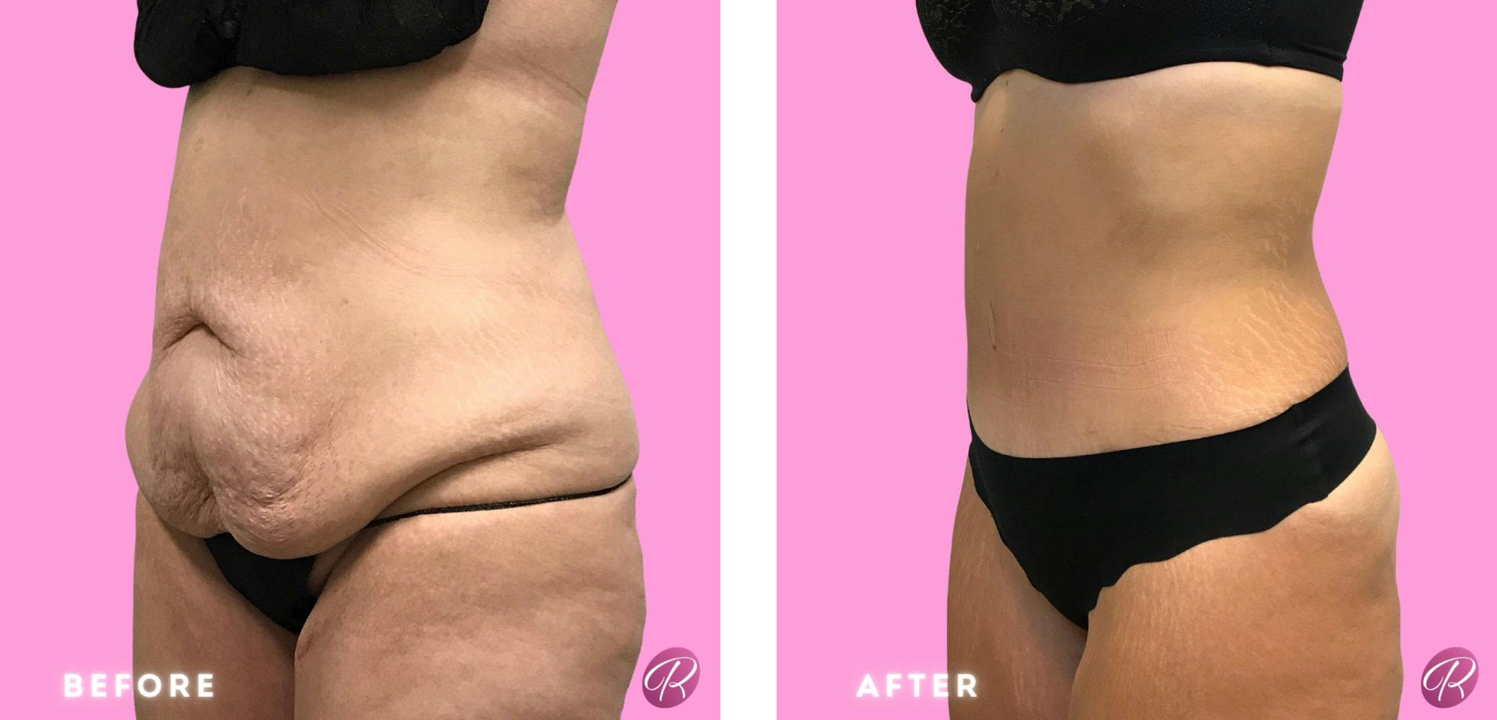 Tummy Tuck and Abdominoplasty Before & After Gallery - Patient 86641344 - Image 2