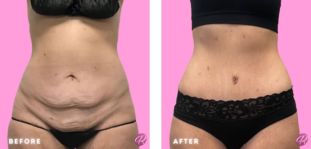 Tummy Tuck and Abdominoplasty Before & After Gallery - Patient 86641344 - Image 1