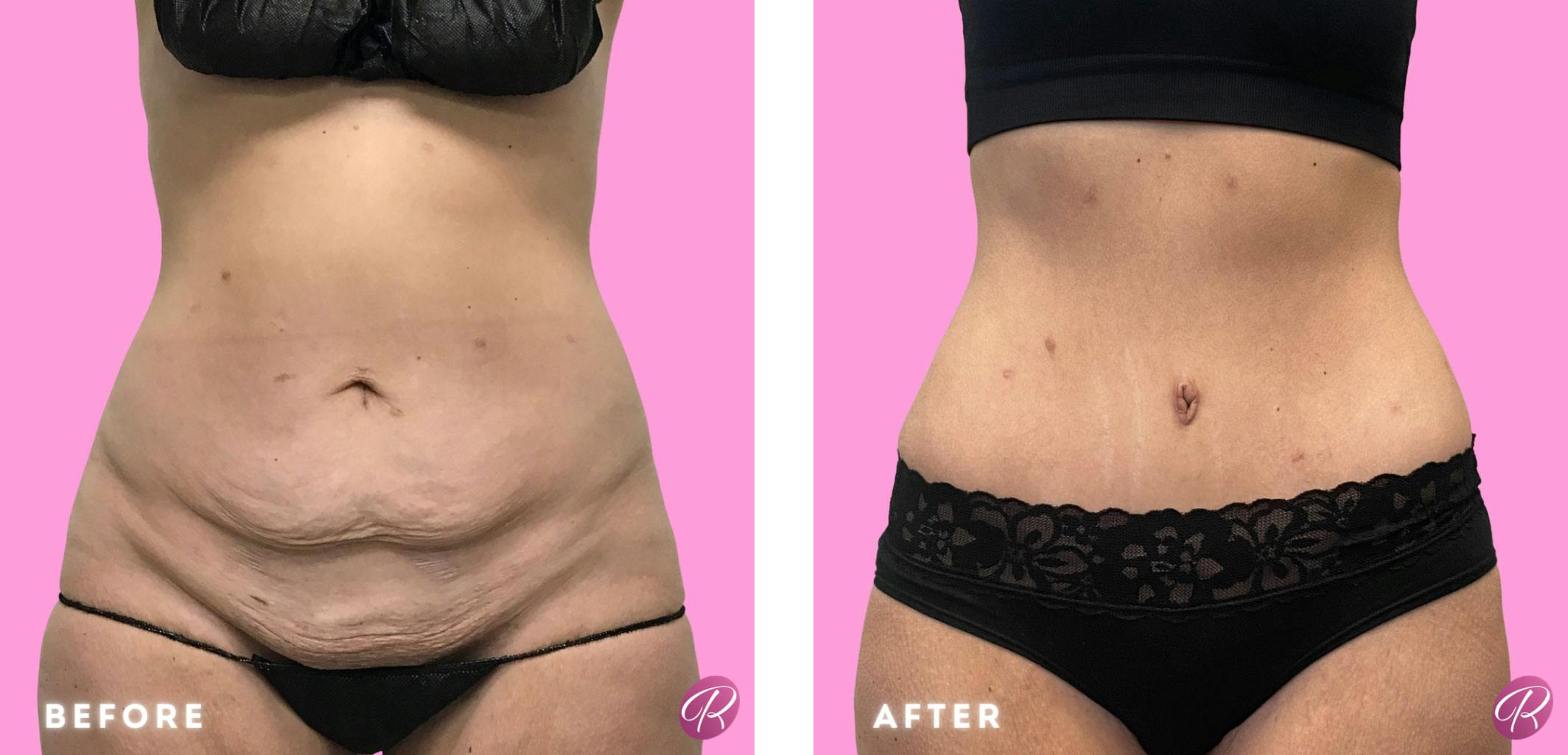 Tummy Tuck and Abdominoplasty Before & After Gallery - Patient 86641344 - Image 1