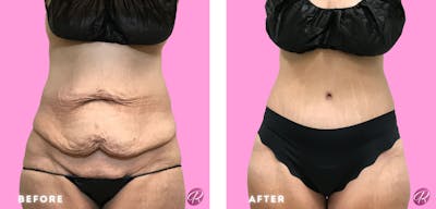 Tummy Tuck and Abdominoplasty Before & After Gallery - Patient 86641368 - Image 1