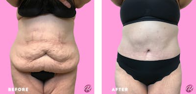 Tummy Tuck and Abdominoplasty Before & After Gallery - Patient 86641384 - Image 1