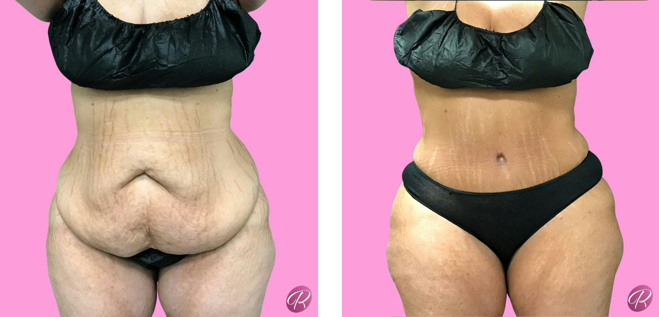 Tummy Tuck and Abdominoplasty Before & After Gallery - Patient 86641393 - Image 1