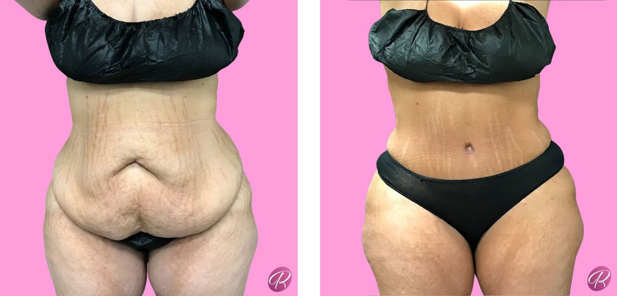 Tummy Tuck and Abdominoplasty Before & After Gallery - Patient 86641393 - Image 1