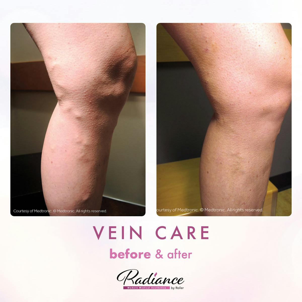 Veins Before & After Gallery - Patient 89194587 - Image 1