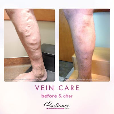 Veins Before & After Gallery - Patient 89194588 - Image 1