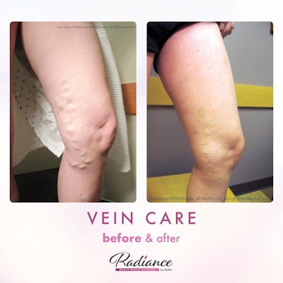 Veins Before & After Gallery - Patient 89194589 - Image 1