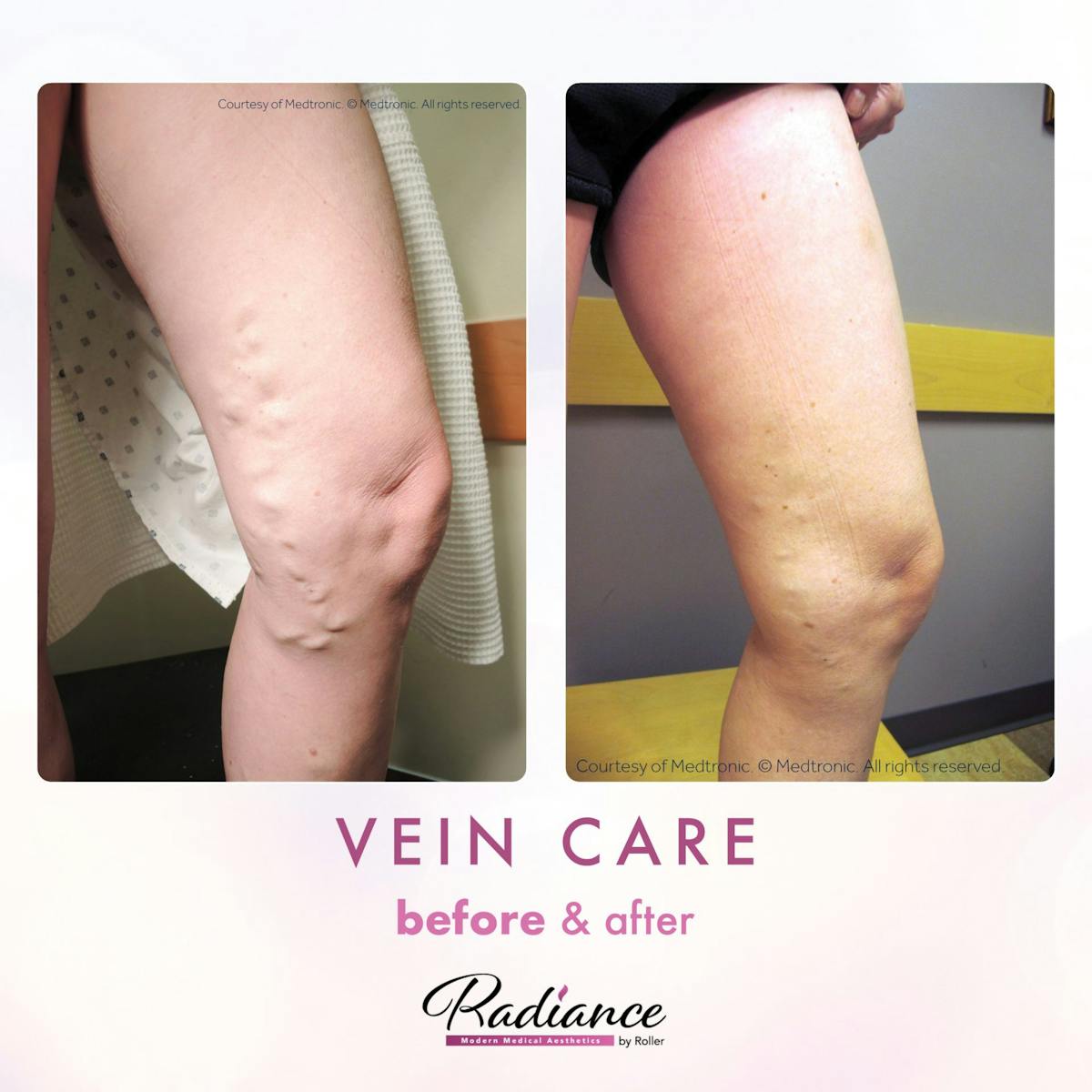 Veins Before & After Gallery - Patient 89194589 - Image 1