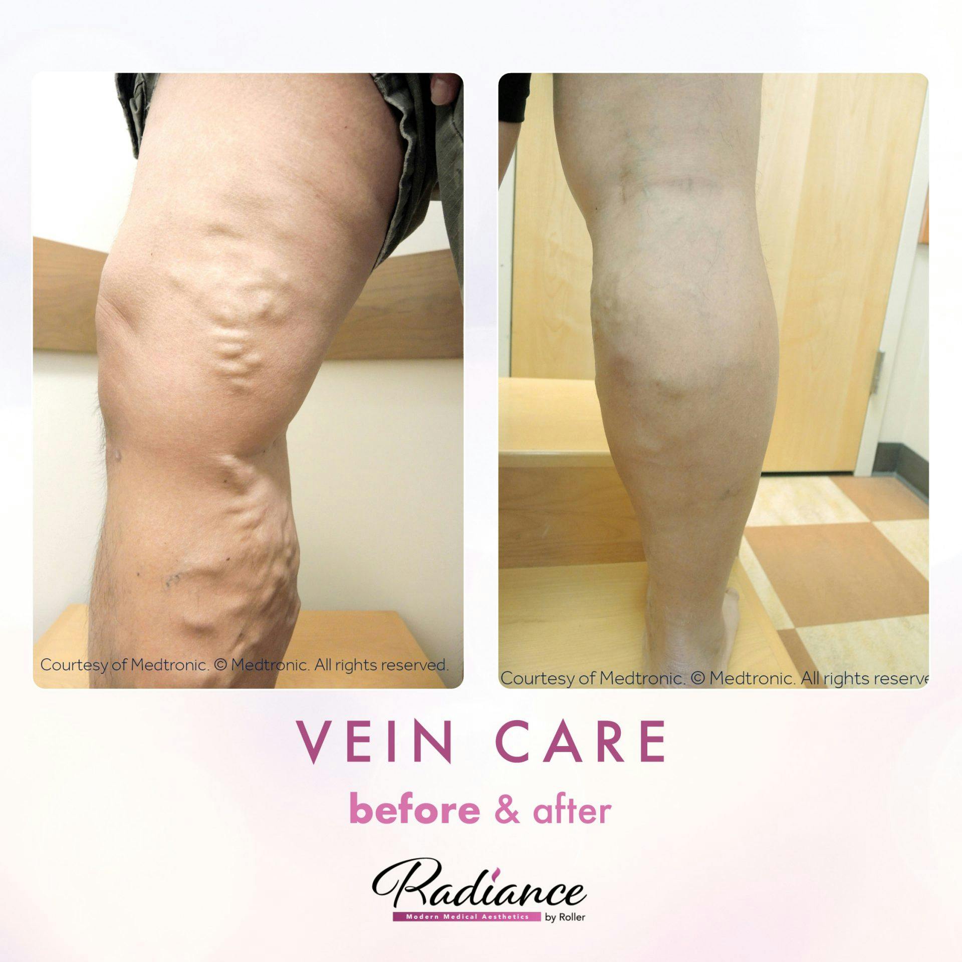 Veins Before & After Gallery - Patient 89194590 - Image 1