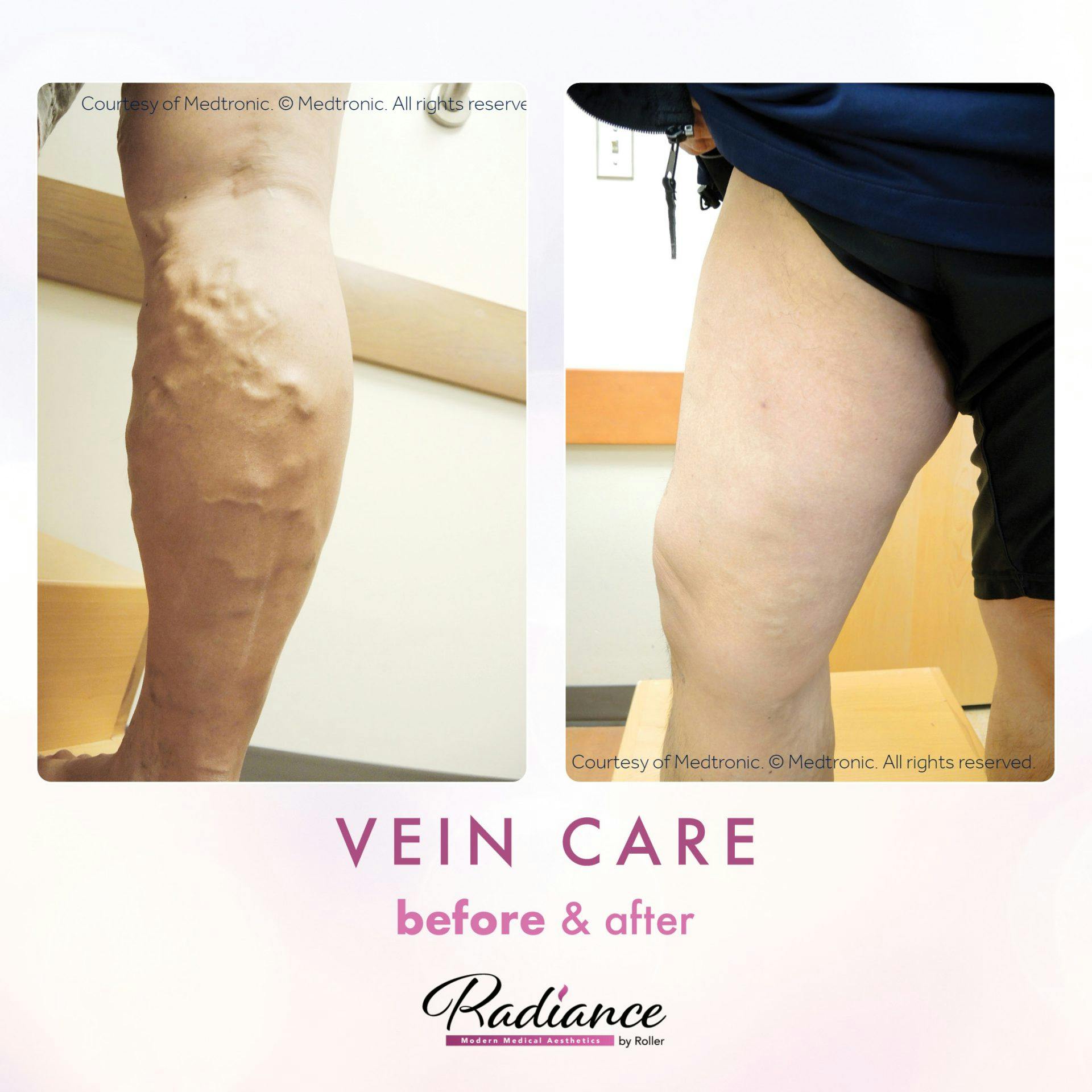 Veins Before & After Gallery - Patient 89194591 - Image 1