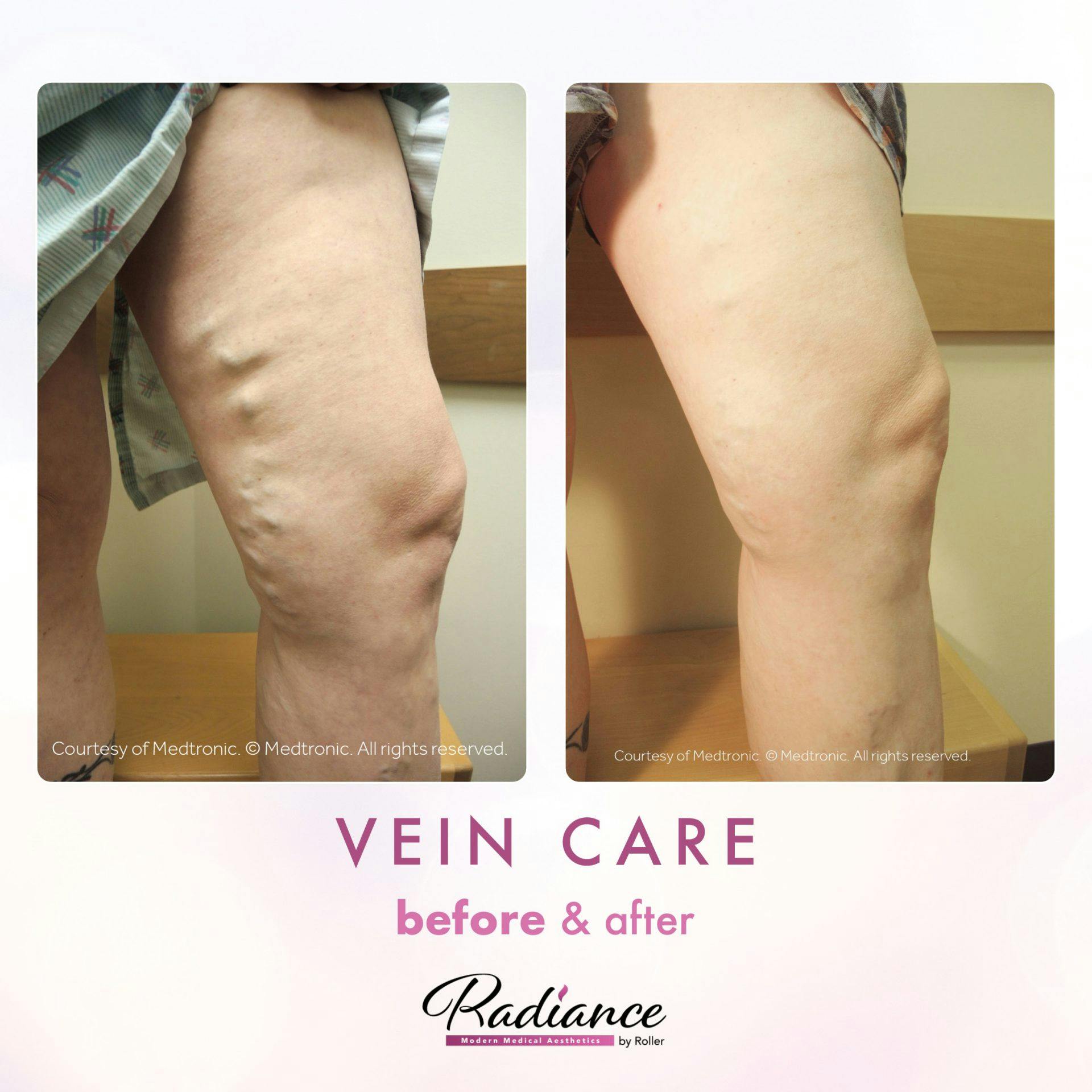 Veins Before & After Gallery - Patient 89194592 - Image 1