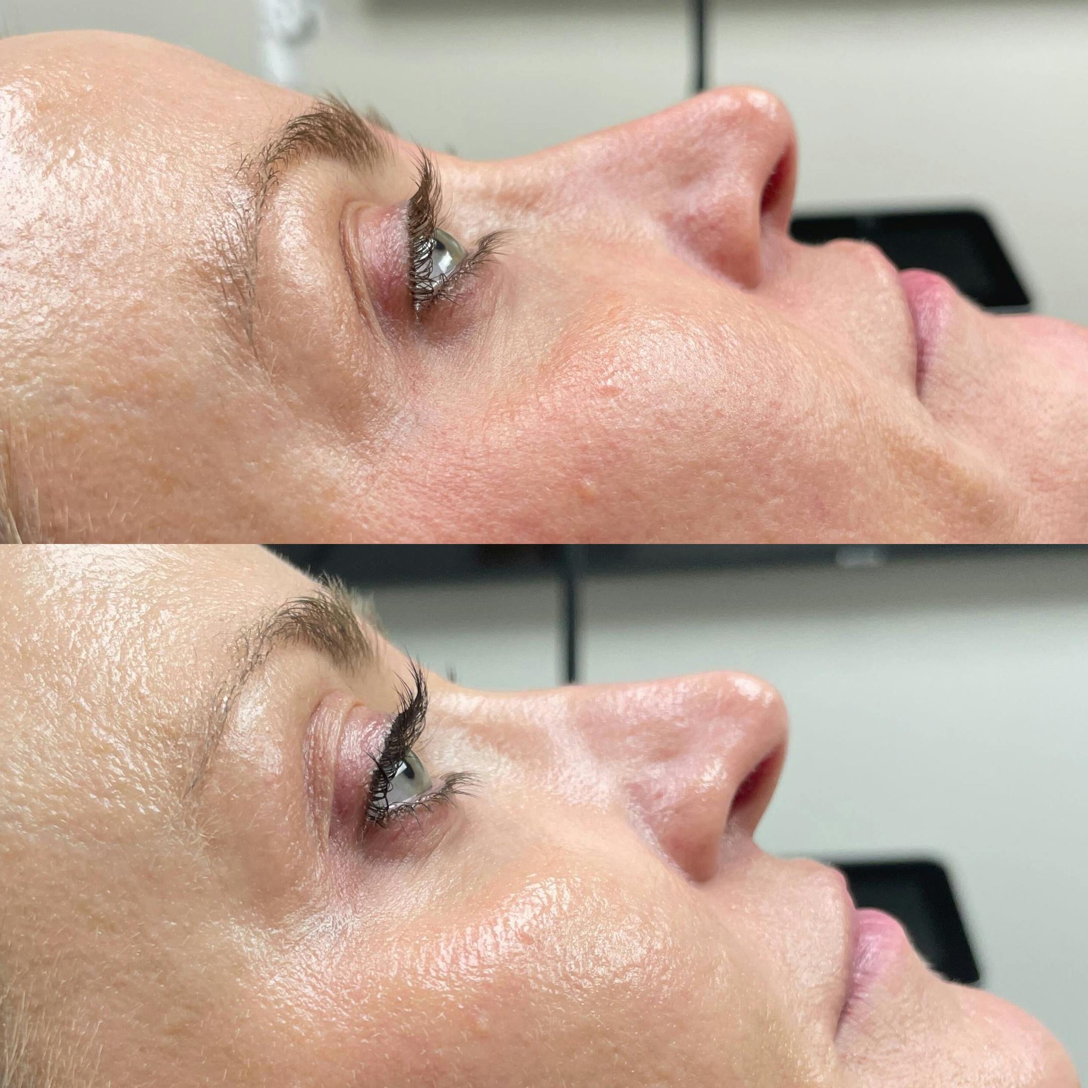 Lash Lift & Tint Before & After Gallery - Patient 133214036 - Image 1