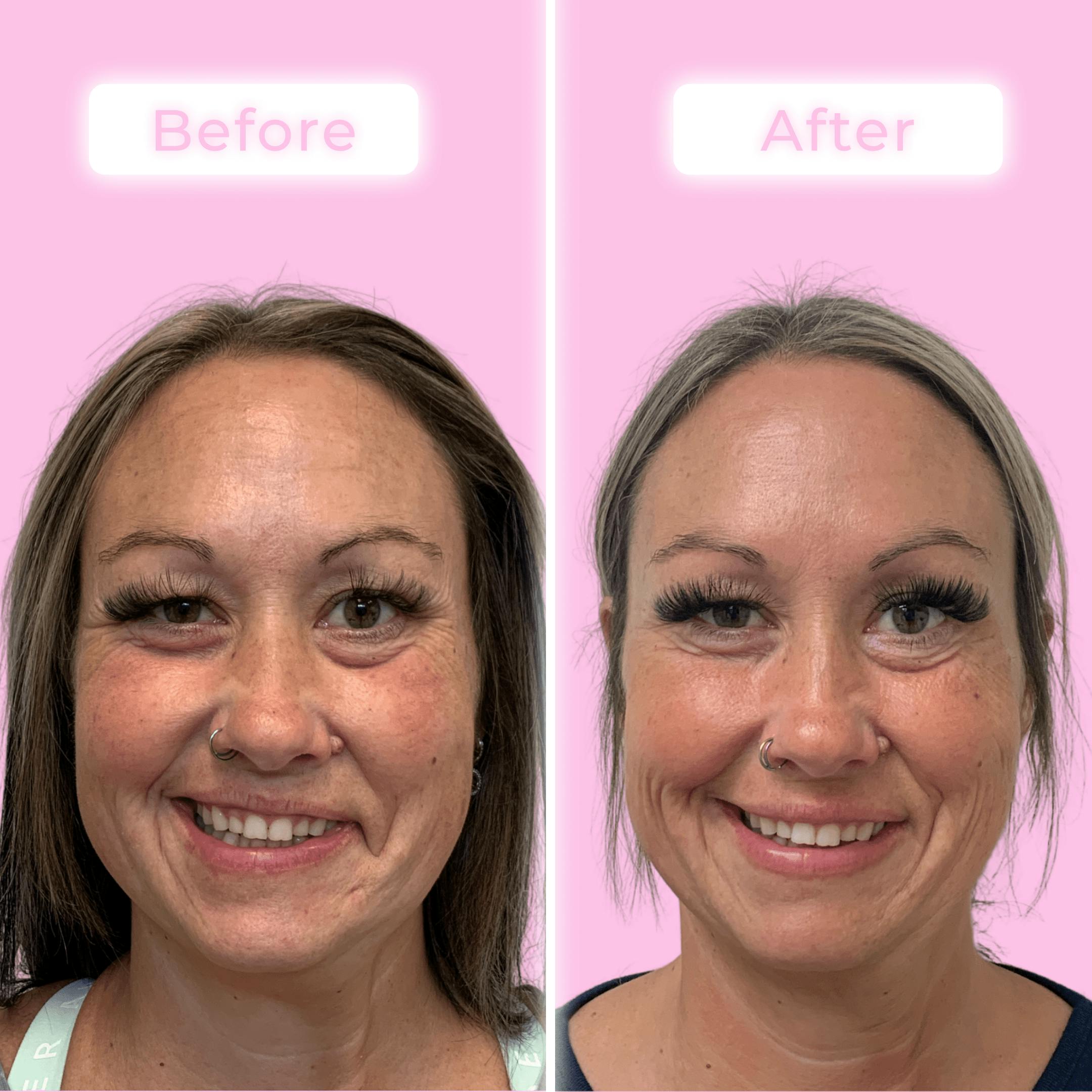Fillers Before & After Gallery - Patient 133227146 - Image 1