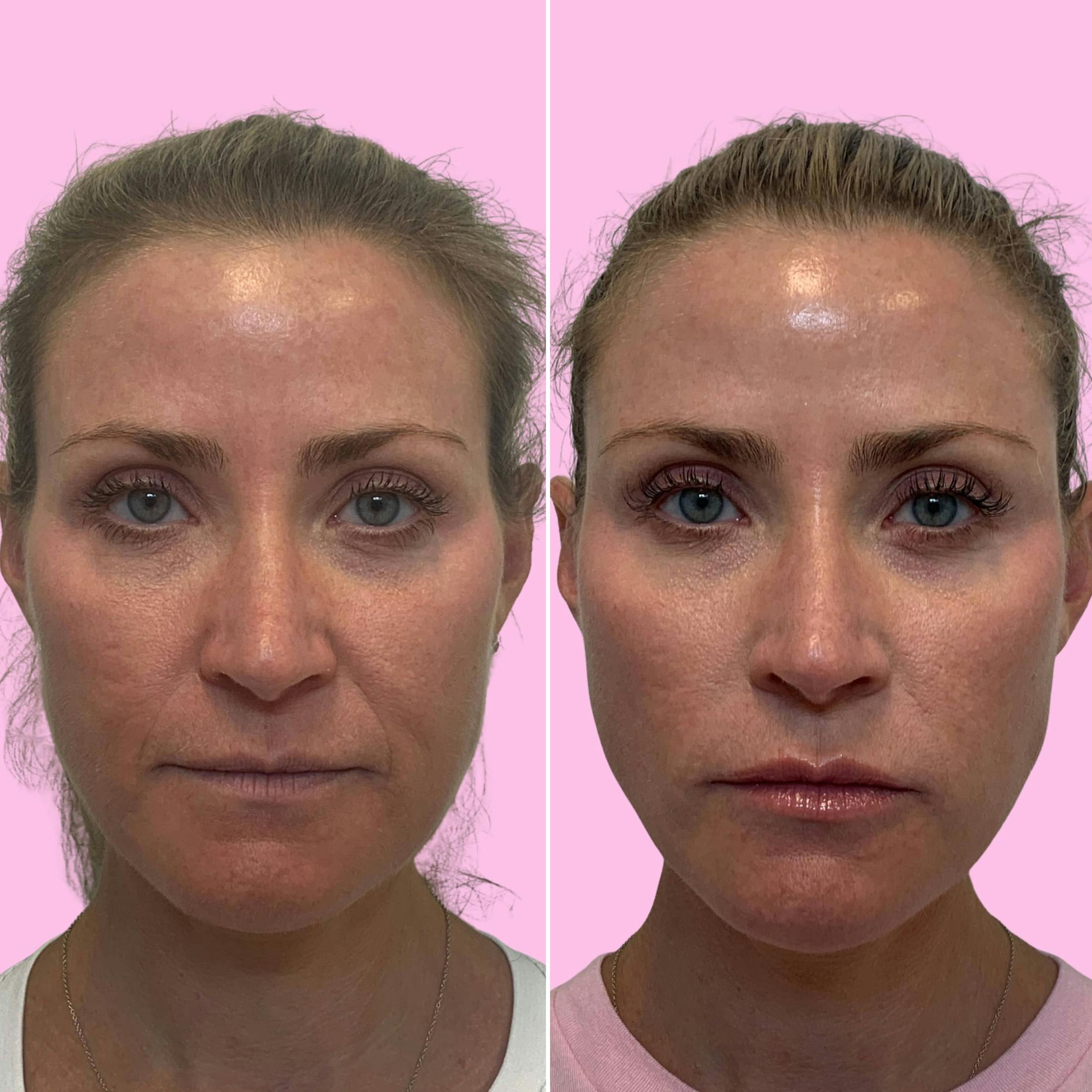 Fillers Before & After Gallery - Patient 133227147 - Image 1