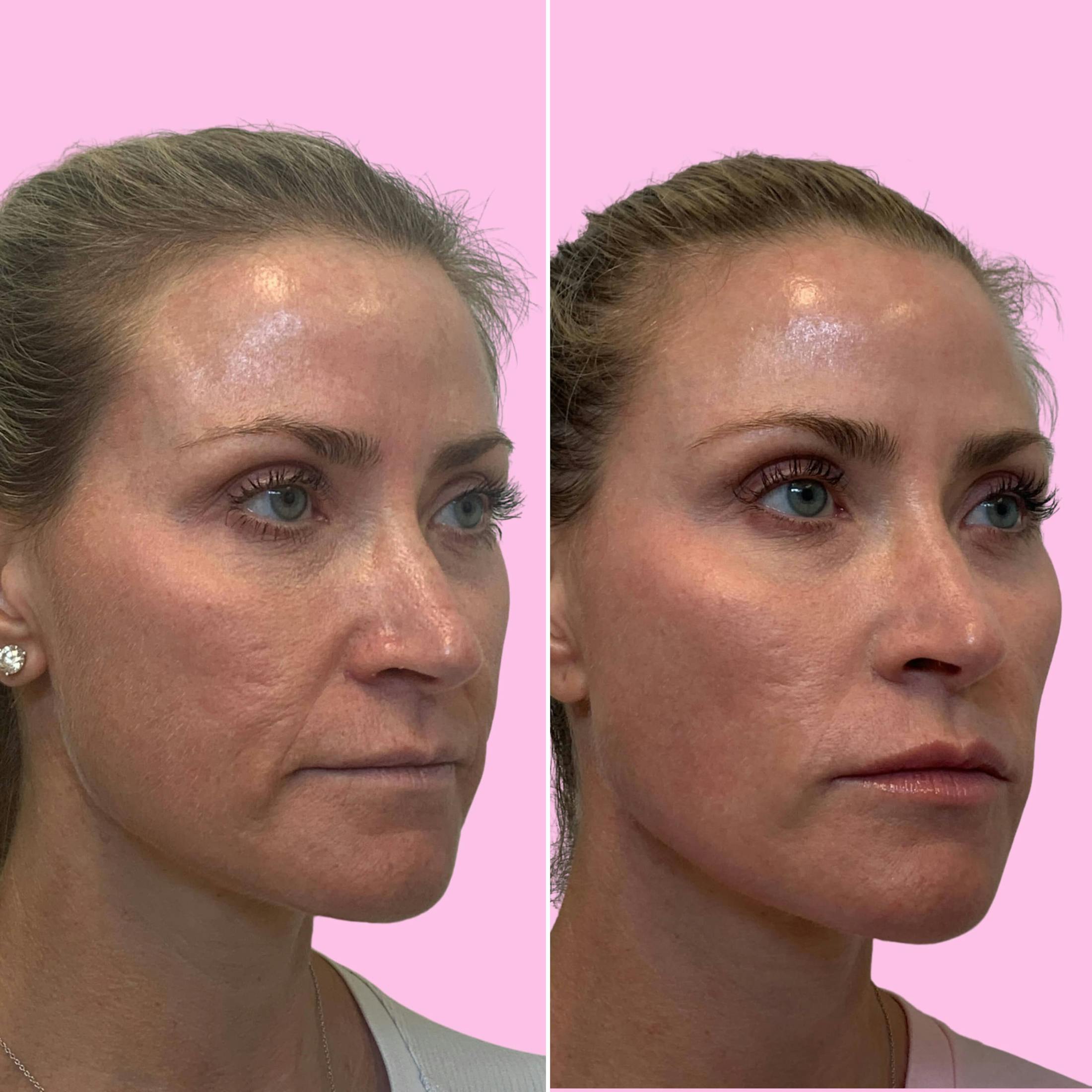 Fillers Before & After Gallery - Patient 133227147 - Image 2