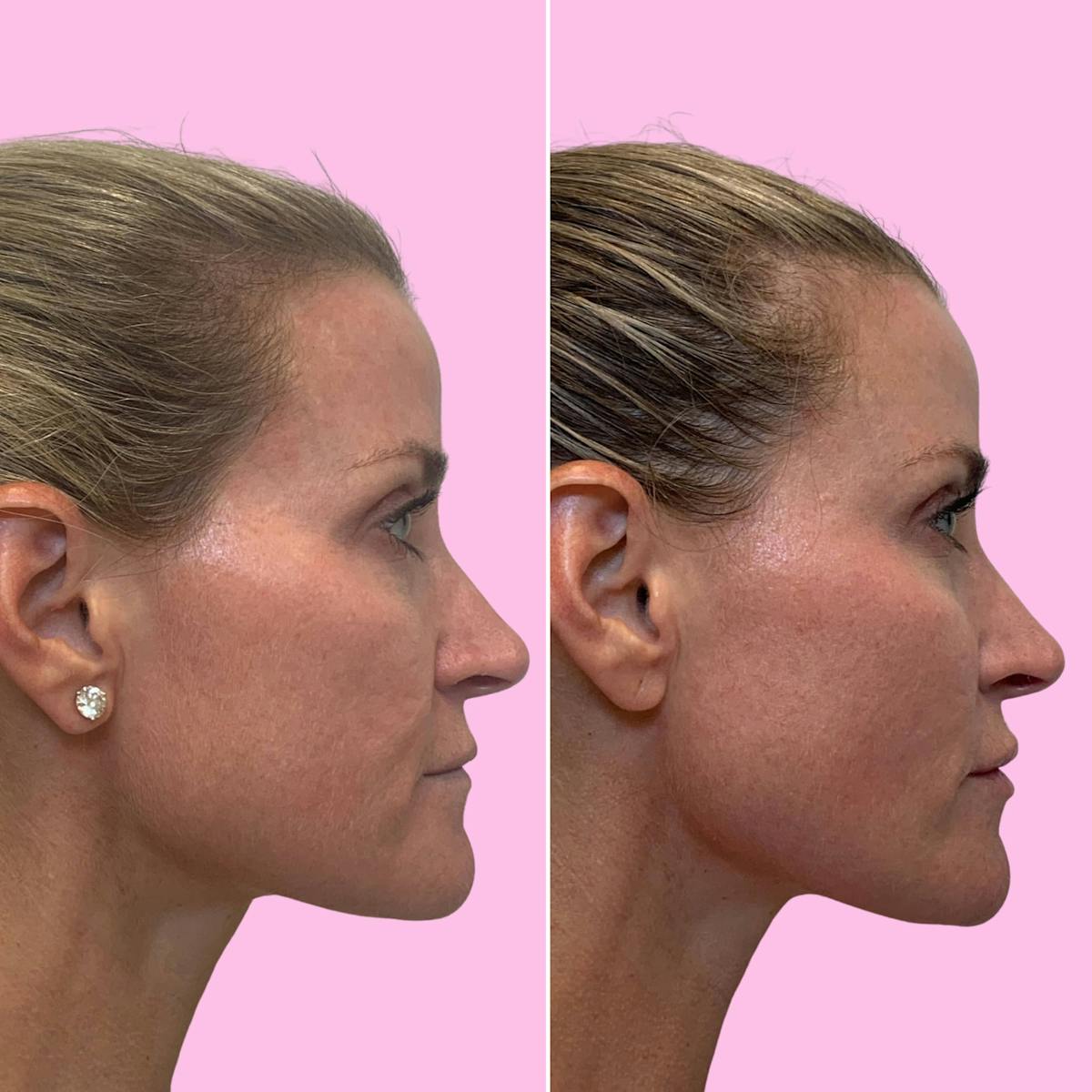 Fillers Before & After Gallery - Patient 133227147 - Image 3