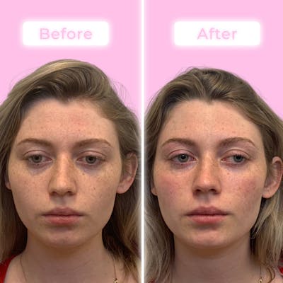 Fillers Before & After Gallery - Patient 133227148 - Image 1