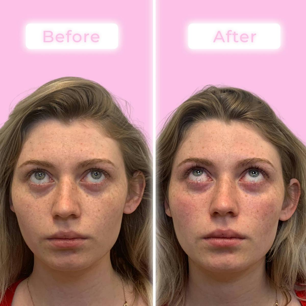 Fillers Before & After Gallery - Patient 133227148 - Image 2