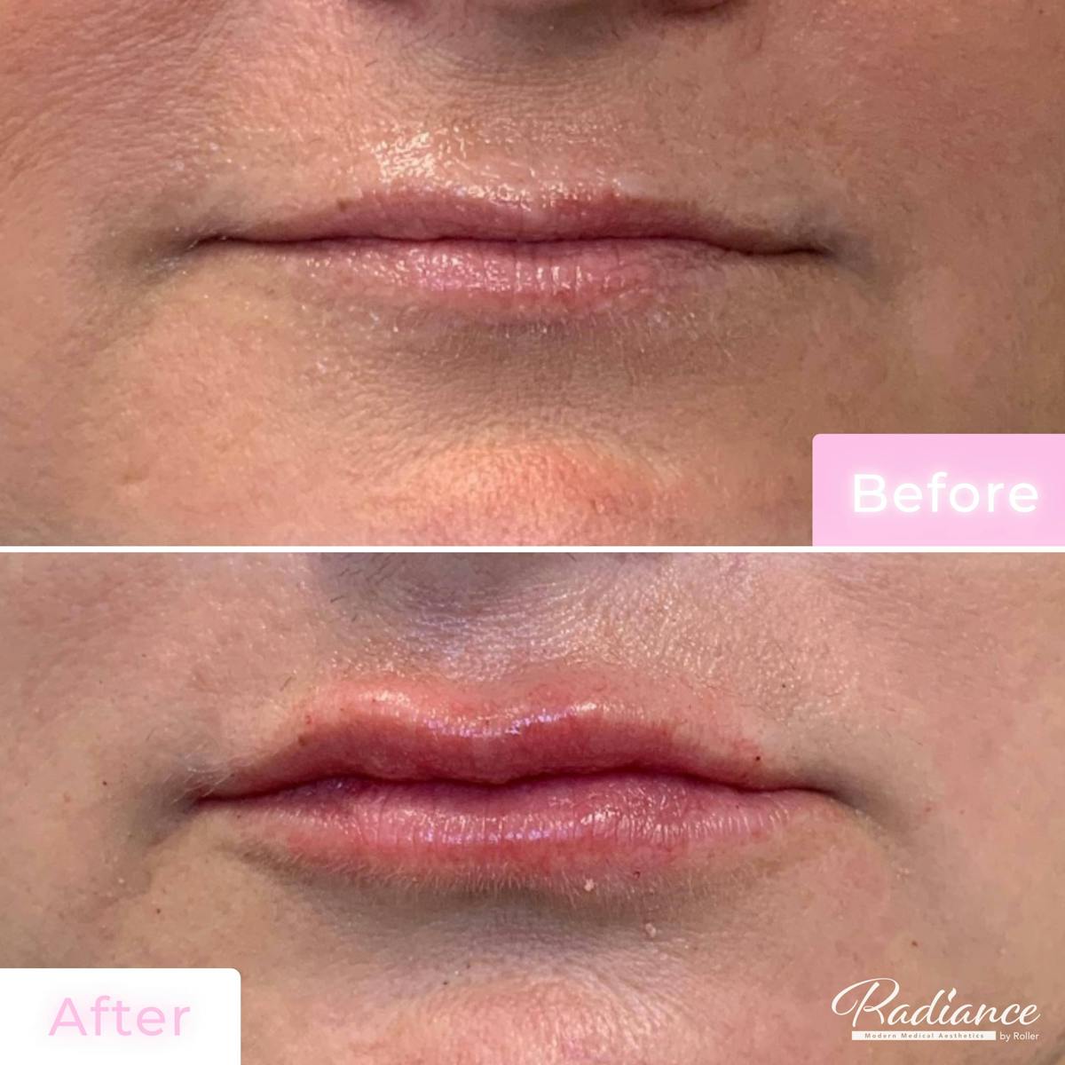 Fillers Before & After Gallery - Patient 133227157 - Image 1