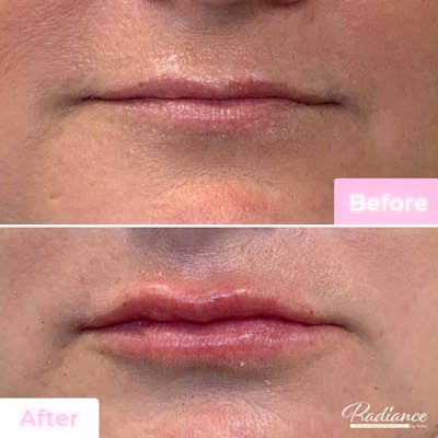 Fillers Before & After Gallery - Patient 133227157 - Image 1