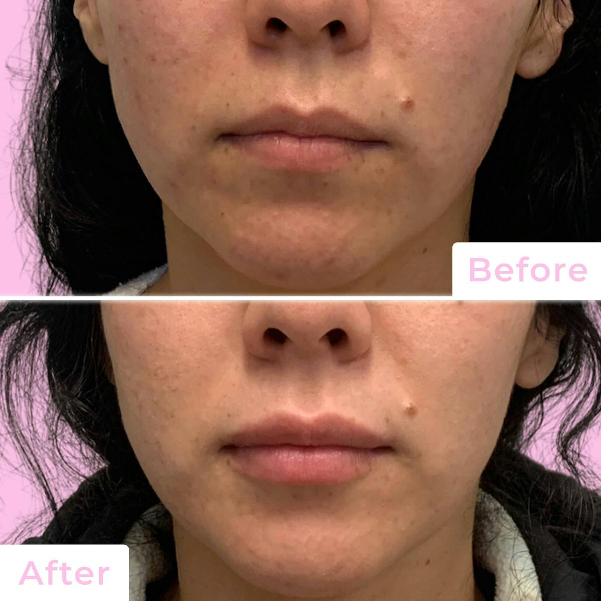 Fillers Before & After Gallery - Patient 133227155 - Image 1