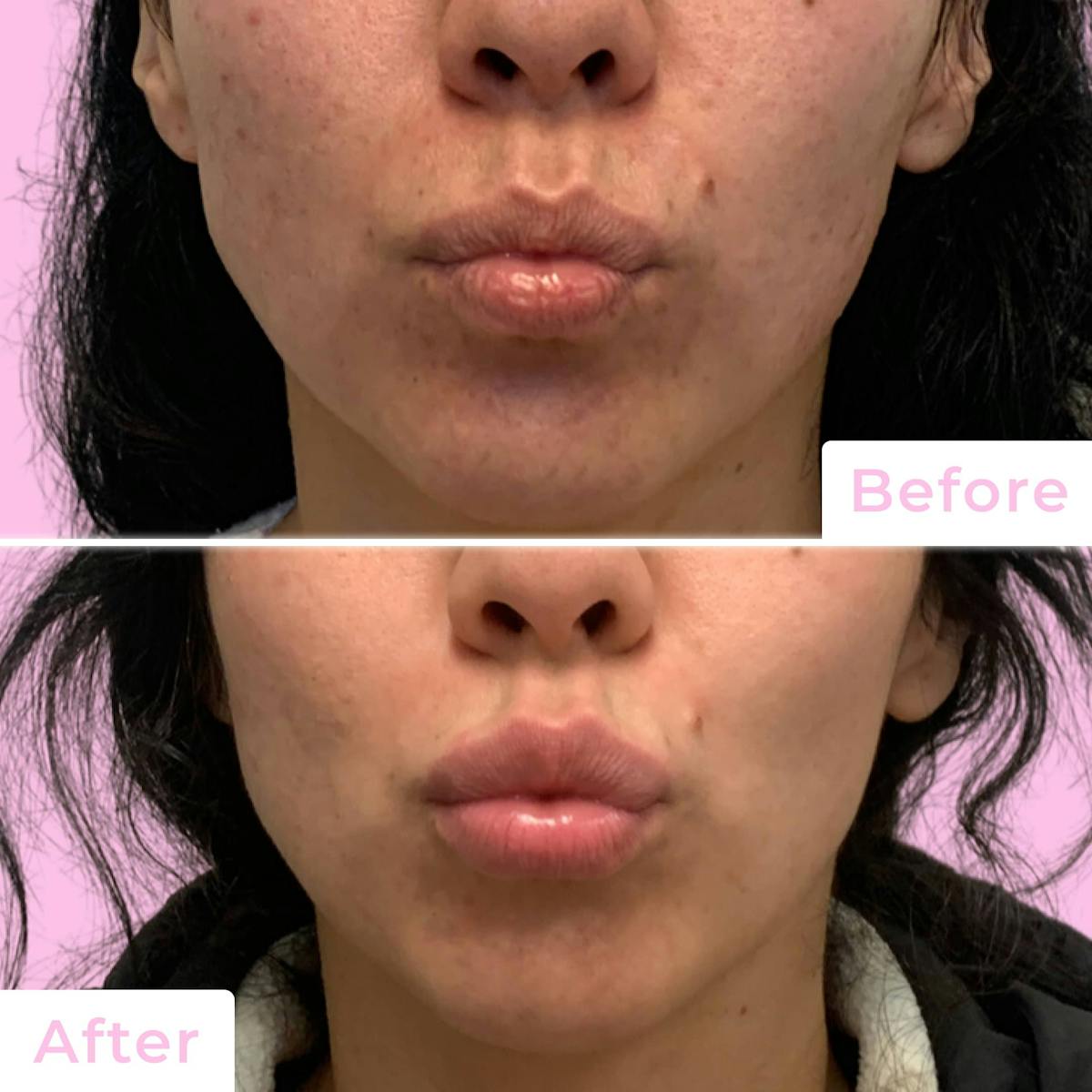 Fillers Before & After Gallery - Patient 133227155 - Image 2