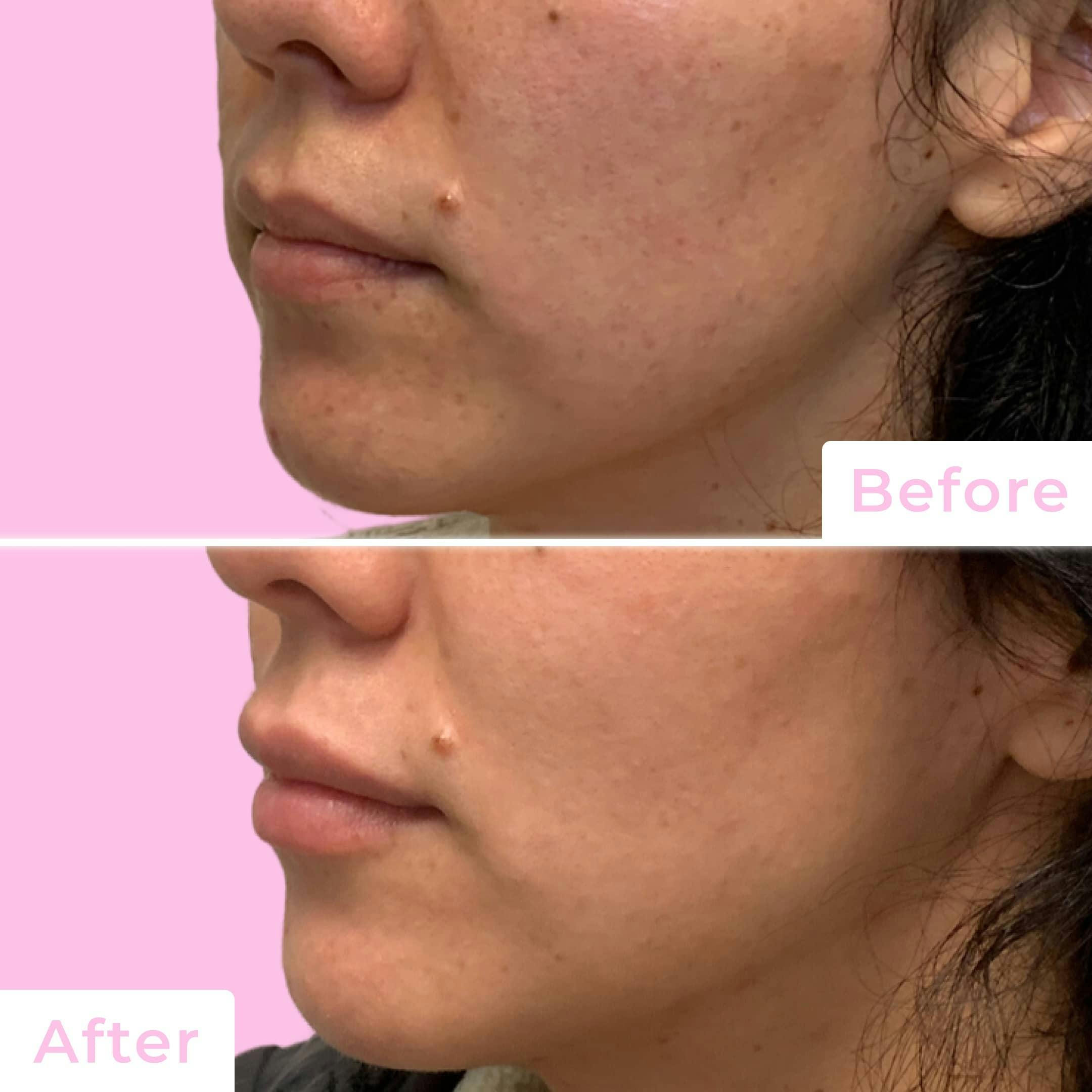 Fillers Before & After Gallery - Patient 133227155 - Image 3