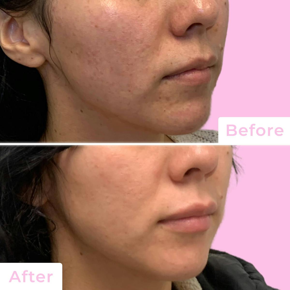 Fillers Before & After Gallery - Patient 133227155 - Image 4