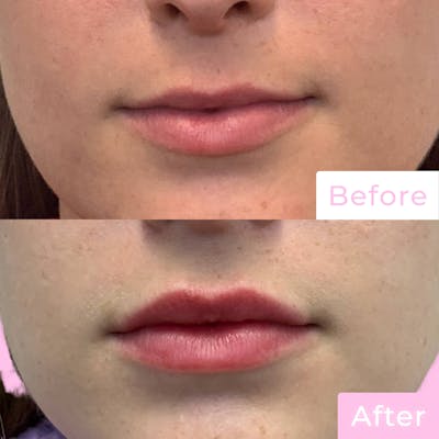 Fillers Before & After Gallery - Patient 133227149 - Image 1