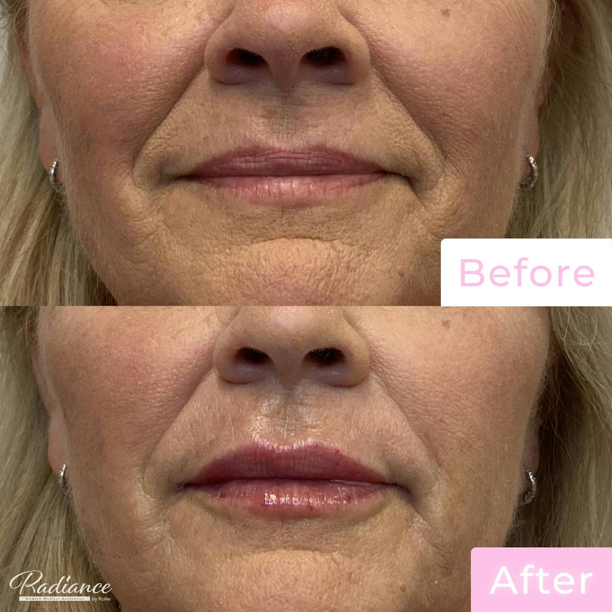 Fillers Before & After Gallery - Patient 133227150 - Image 1