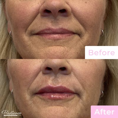 Fillers Before & After Gallery - Patient 133227150 - Image 1