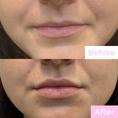 Fillers Before & After Gallery - Patient 133227151 - Image 1