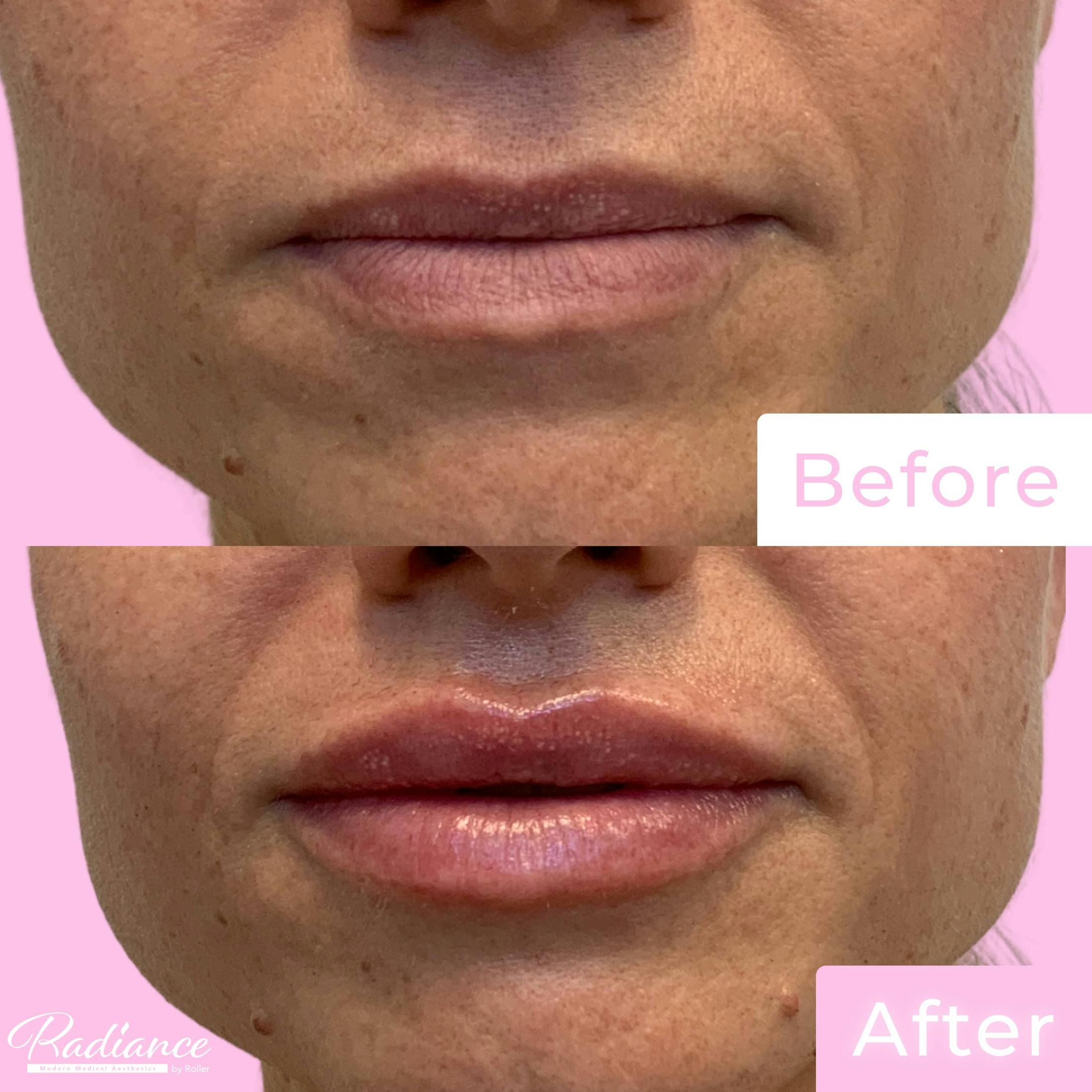 Fillers Before & After Gallery - Patient 133227152 - Image 1