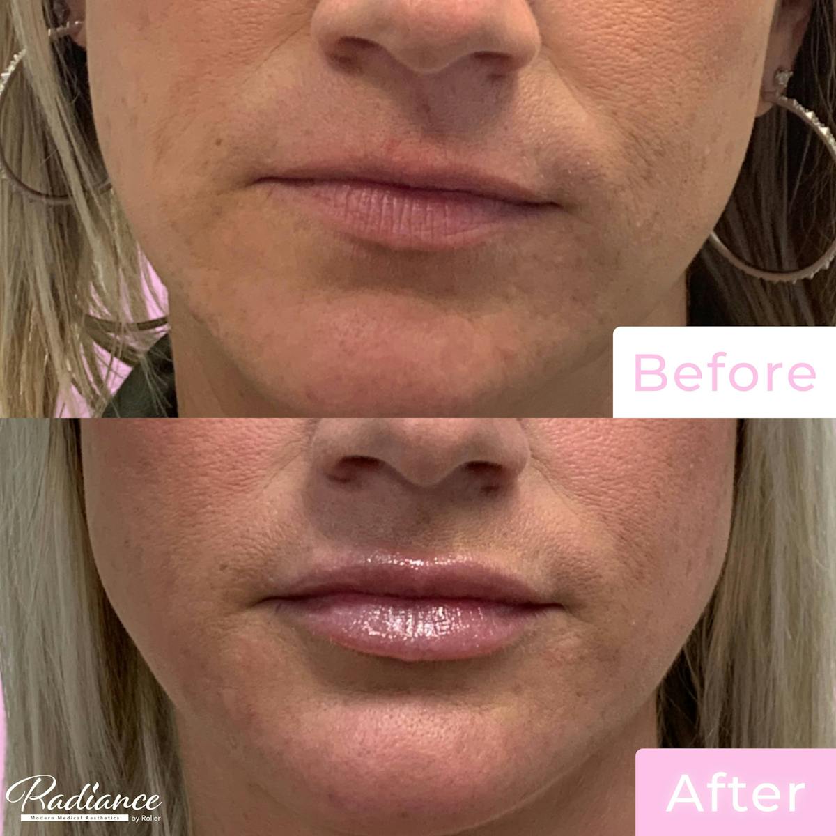 Fillers Before & After Gallery - Patient 133227153 - Image 1