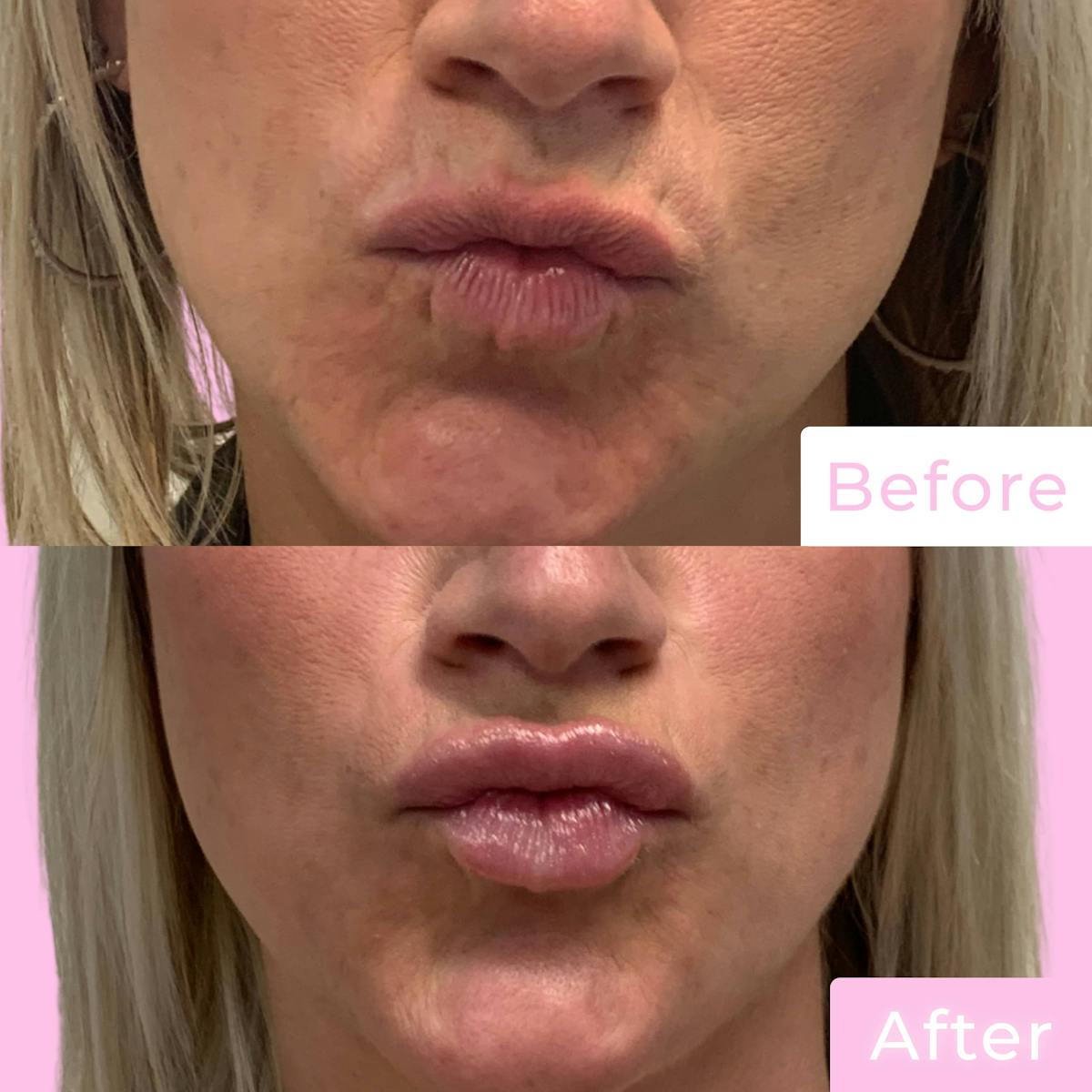 Fillers Before & After Gallery - Patient 133227153 - Image 2