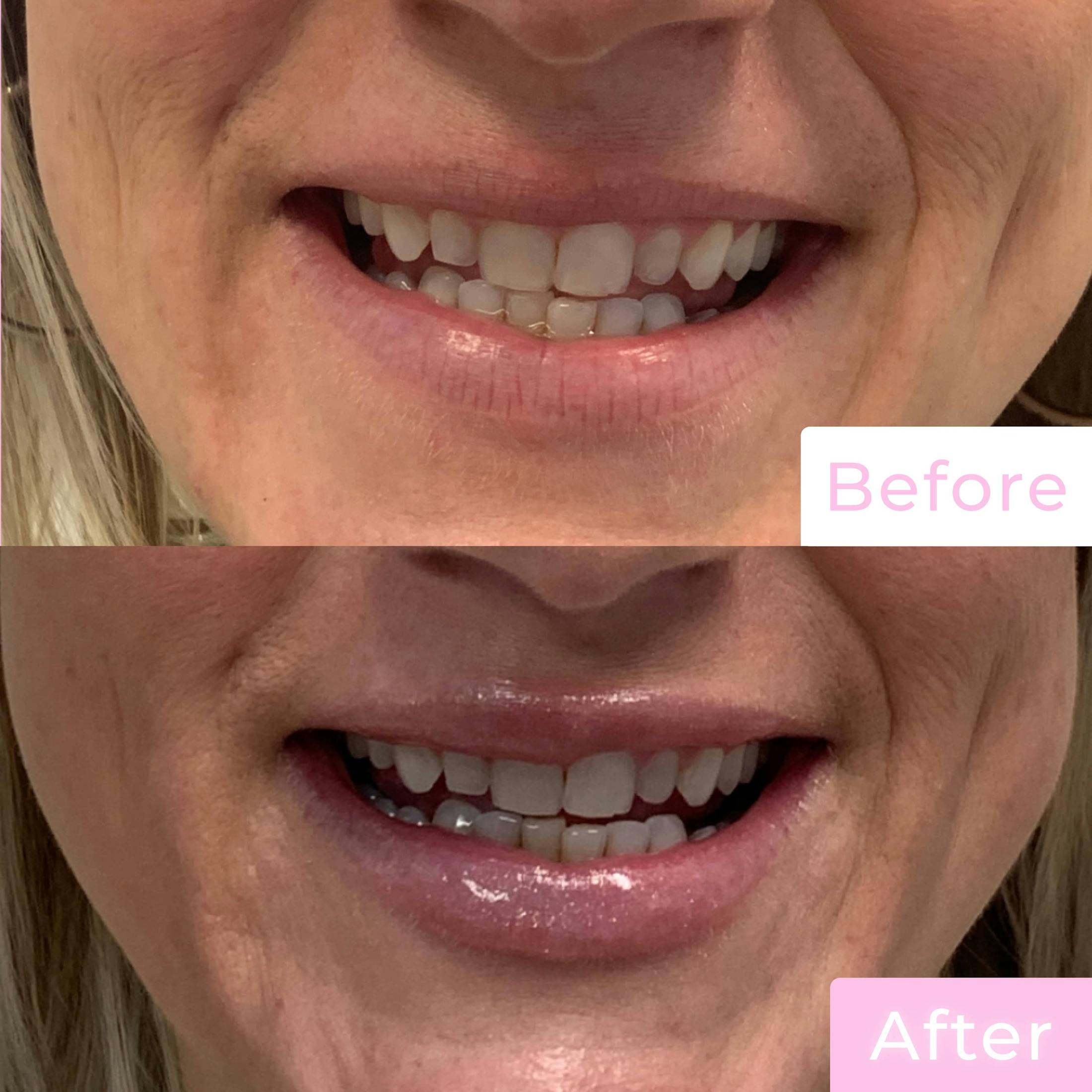 Fillers Before & After Gallery - Patient 133227153 - Image 3