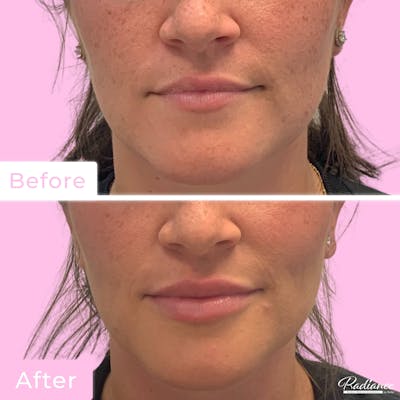 Fillers Before & After Gallery - Patient 133227205 - Image 1
