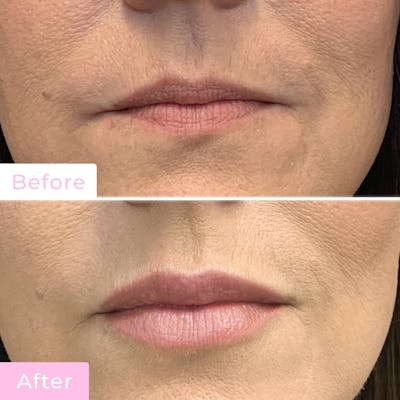 Fillers Before & After Gallery - Patient 133227208 - Image 1