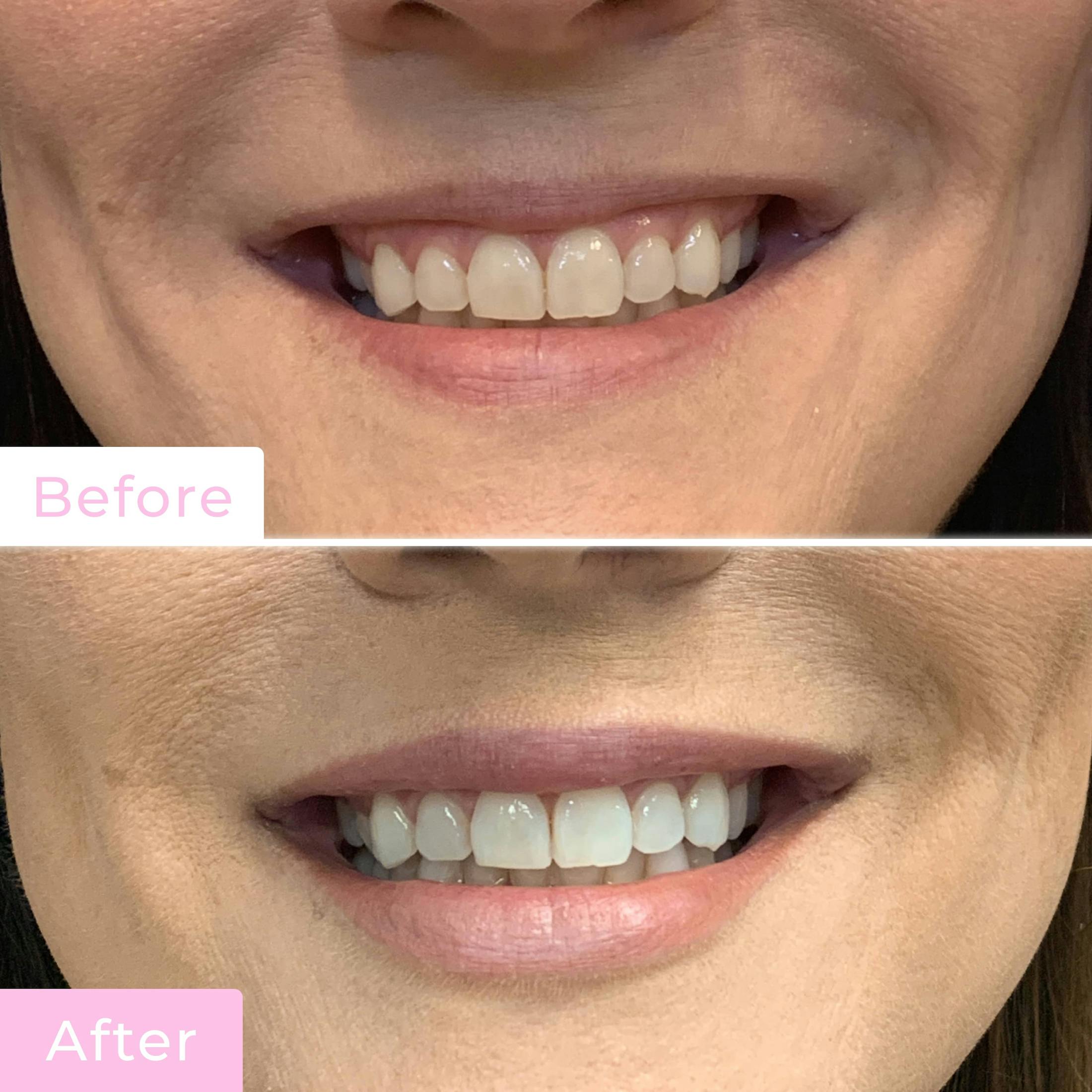 Fillers Before & After Gallery - Patient 133227208 - Image 2