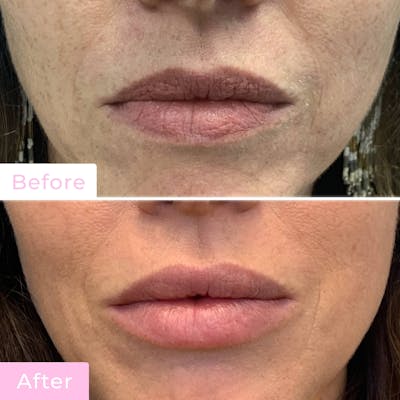 Fillers Before & After Gallery - Patient 133227207 - Image 1