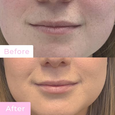 Fillers Before & After Gallery - Patient 133227206 - Image 1