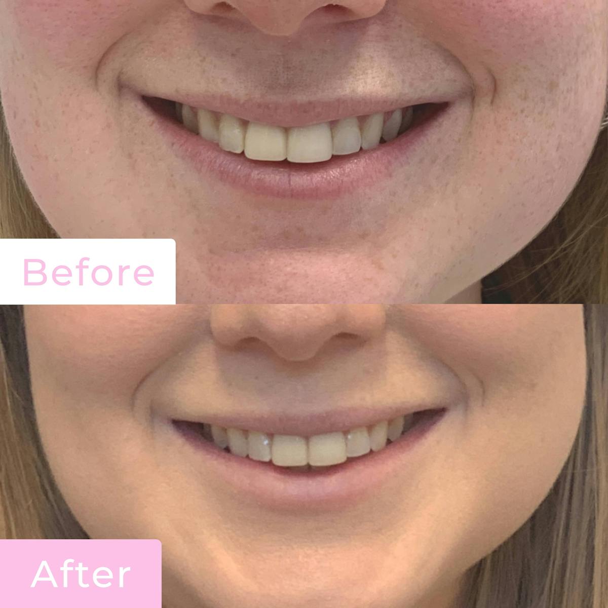 Fillers Before & After Gallery - Patient 133227206 - Image 2