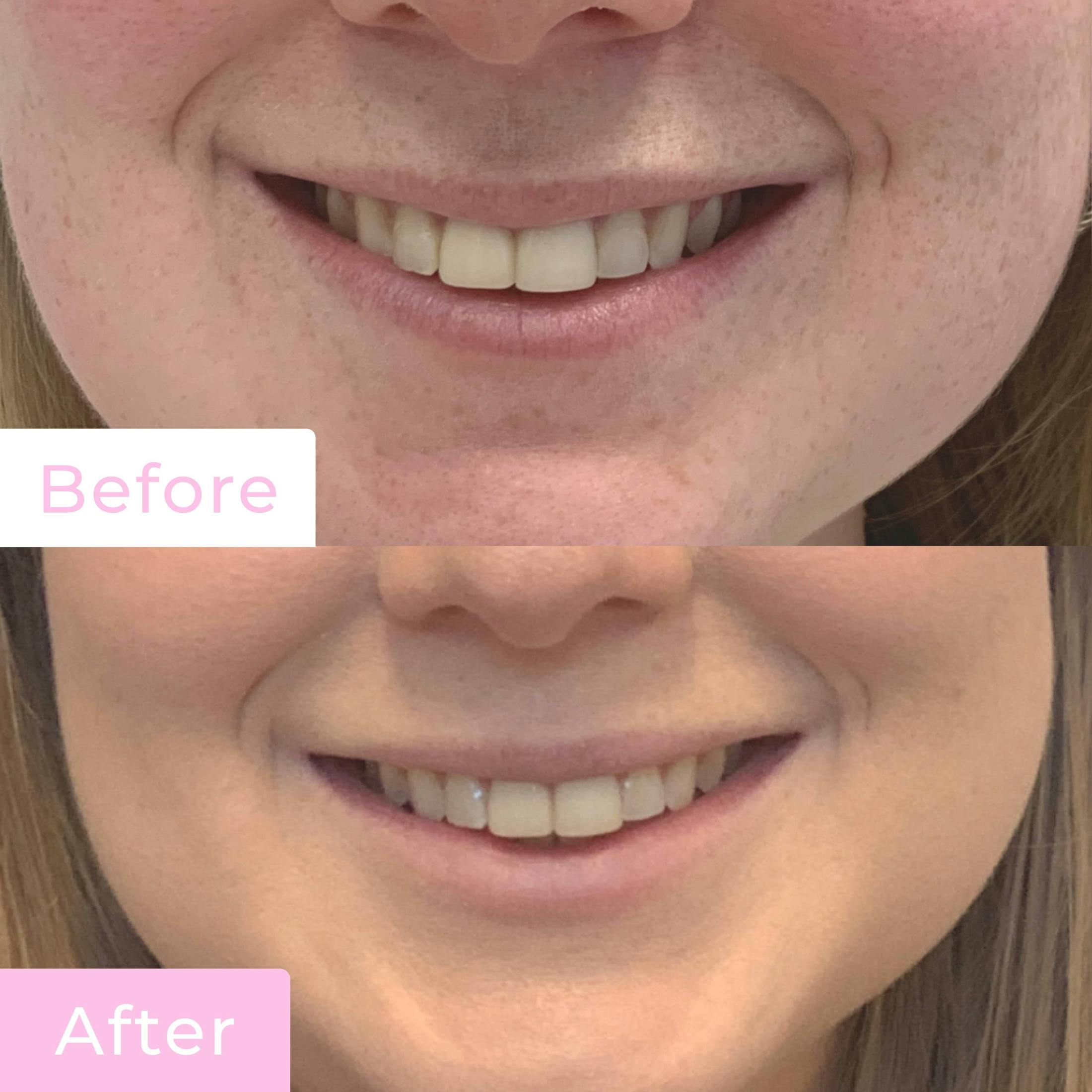 Fillers Before & After Gallery - Patient 133227206 - Image 2