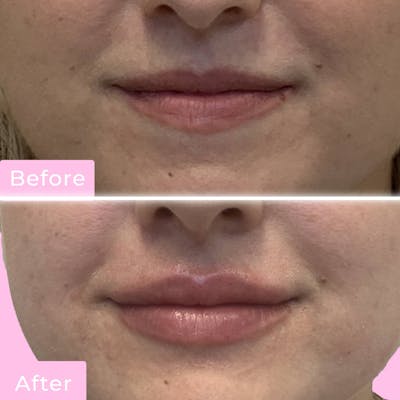 Lip Flip Before & After Gallery - Patient 133227214 - Image 1