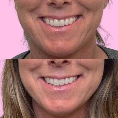 Lip Flip Before & After Gallery - Patient 133227217 - Image 1